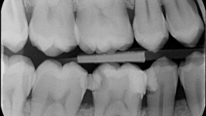 Vier jaar later: case report endodontische behandeling 46
