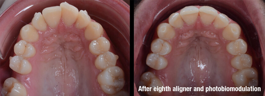 Fig. 4: Antes (esquerda) e depois (direita). O caso foi resolvido ao longo de dois meses com oito alinhadores transparentes (Smilers) e terapia de fotobiomodulação (com o ATP38), aplicada todas as semanas durante seis minutos sempre que os alinhadores eram mudados.