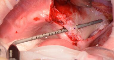 Il trattamento delle gravi atrofie mascellari con impianti zigomatici: una nuova Tecnica Minimamente Invasiva con strumentazione piezoelettrica