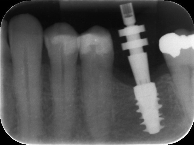 Fig. 9: Impression post engaged on to the implant correctly—no gap visible.