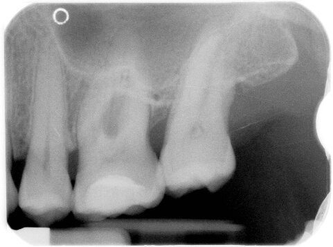 Fig. 5n - Radiografia a 2 anni.