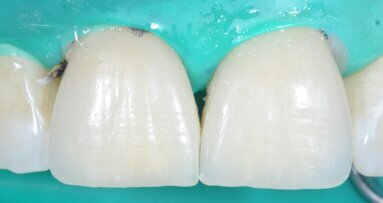 Clinical case: Central incisor veneers with PANAVIA V5