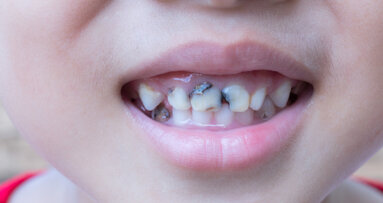 Interview: “Communities without fluoridated water have a higher incidence of dental caries”