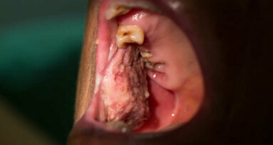 Kryzys COVID-19 może negatywnie wpłynąć na wykrywalność nowotworów jamy ustnej