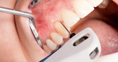 Ošetření pacientů s parodontitidou lineárním ultrazvukem Vector Paro