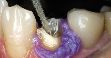 S čepem nebo bez čepu – otázka míry destrukce zubních tkání