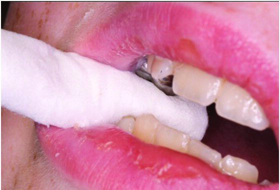 Figure 7: The Hall Technique: The patient bites on a cotton wool roll to allow the SSC to “snap” on the tooth number 54. A click is occasionally heard.