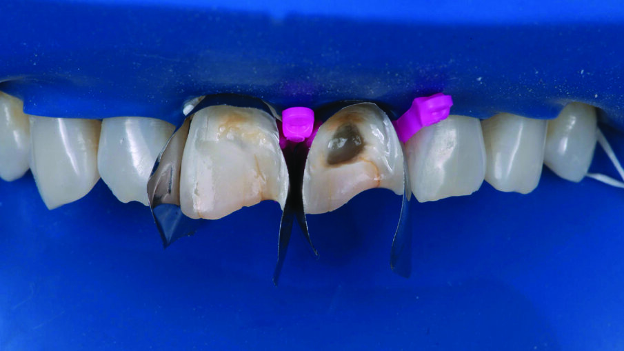 Two anterior matrices were placed to help create a natural anterior tooth shape and facilitate restoration of the interproximal and cervical margins.