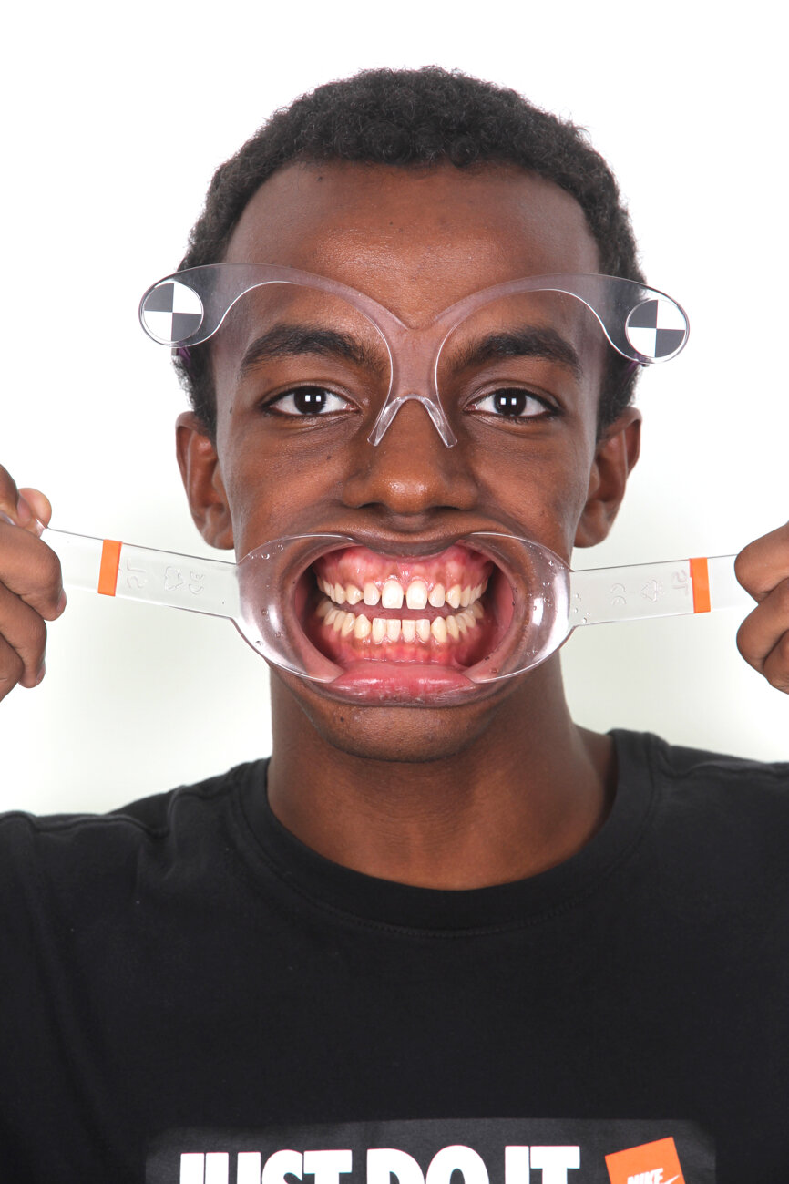 Fig. 11: Digital smile system glasses and digital dental library selected by the software for the smile planning.