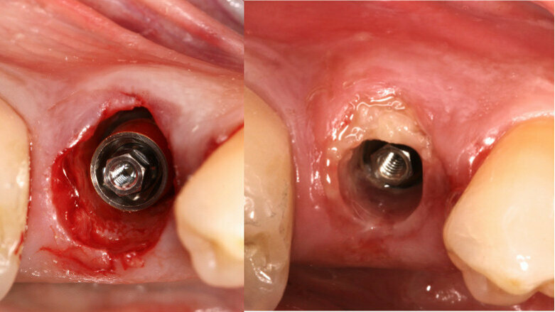 Immediate loading of a socket shield post-extraction implant with the final CAD/CAM crown