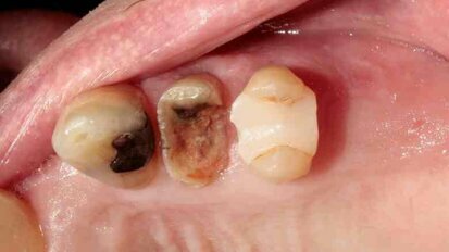 Atraumatic extraction of maxillary first premolar