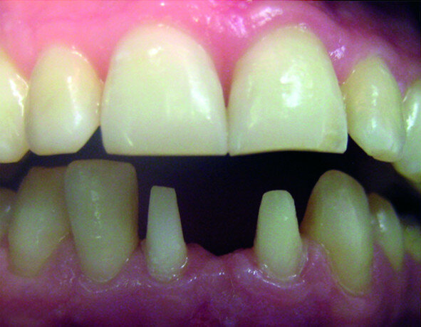 Fig. 11a: Preparation of vital teeth #31 to 42 bridge abutment (a). Digital impressions (CEREC 3.85) (b).
