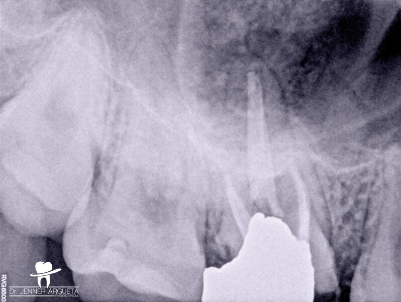 Fig. 2 : Radiographie périapicale de la molaire maxillaire droite. Il est prévu de transplanter la dent 18 dans l’alvéole dentaire 16. 