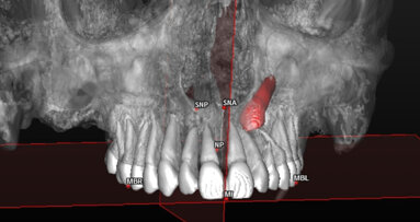 “Impacted canines”: proposta di analisi cefalometrica 3D