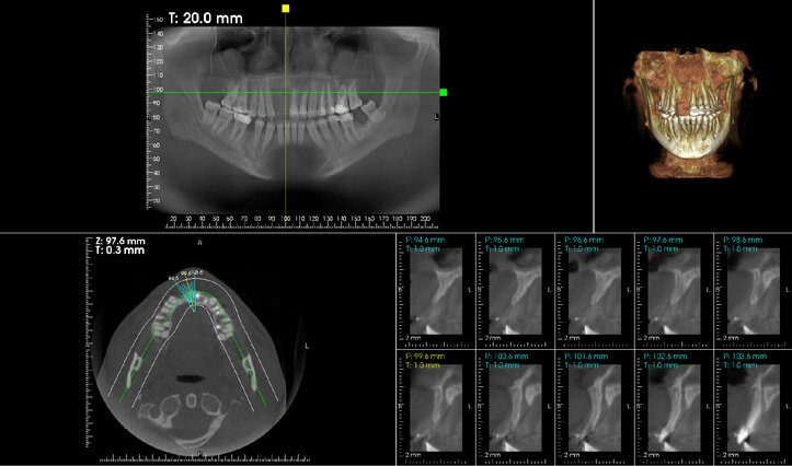 Figure 11: CBCT cross-sectional view of sites no 7 and 8 revealed inadequate ridge width to support implant with restoration.