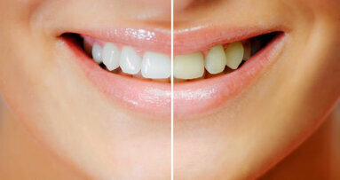 Le blanchiment ou l’éclaircissement des dents est désormais strictement réservé aux chirurgiens-dentistes