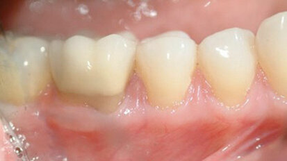 Novel approach to gingival grafting: Single-stage augmentation graft for root coverage