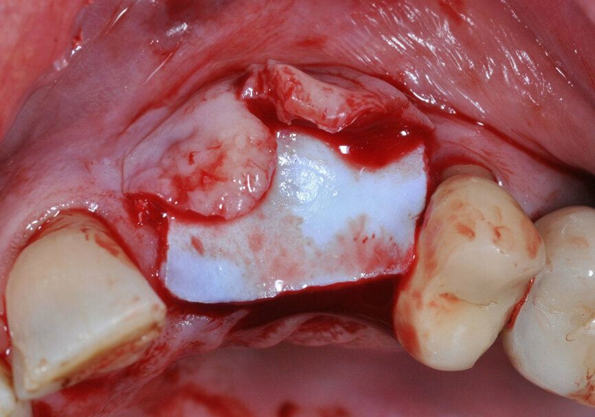 Soft-tissue enhancement with the acellular dermal NovoMatrix. (Image: Inga Boehncke)