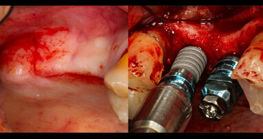 Cirugía implantológica avanzada