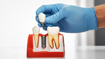 China caps cost of dental implant treatment
