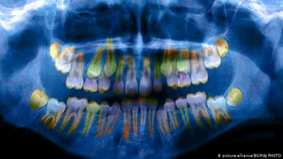Stress levels are reflected in teeth