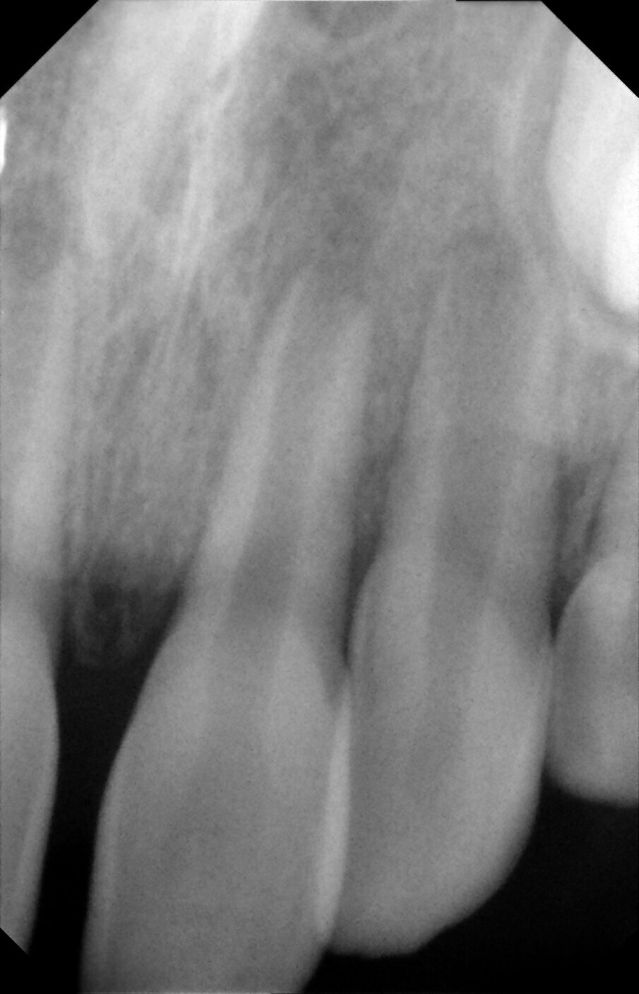 Figure 17a: Post op radiographs taken at 3, 6 and 12 months. They show lack of PDL some pulpal obliteration and replacement resorption. 