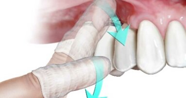 Confermata l’efficacia dello strofinamento con garza nell’eliminazione del Covid-19 dal cavo orale