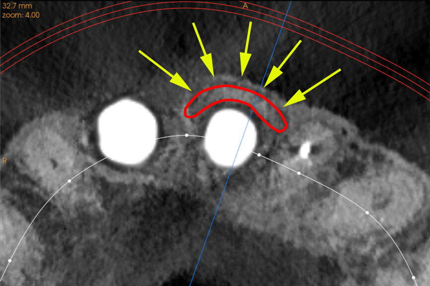 Fig. 27b: The post-op CBCT scan axial view revealed the intact crescent shape of the root membrane (a), as outlined in red in facial to the opaque
implant position (b).