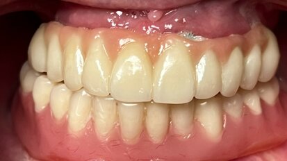 Trattamenti con dentizione terminale in età pre-geriatrica: proposta di un protocollo clinico di Day Dentistry