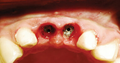 Predictable implant uncovery with diode laser