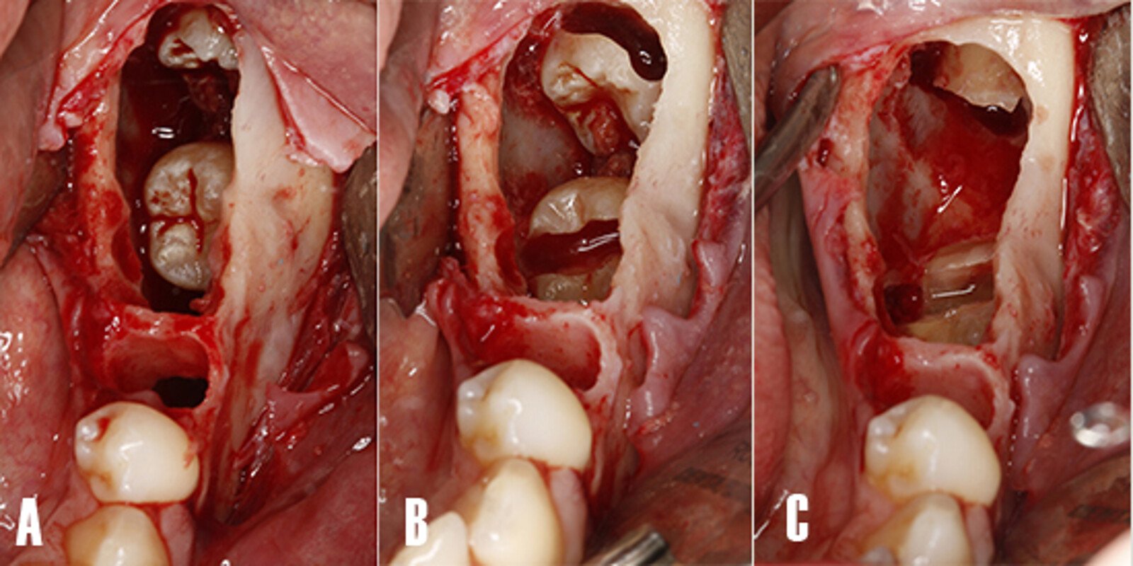 Figura 6. ExtracciÃ³n de los dientes impactados. Imagen intraoral - vista oclusal. A) Tras las extracciÃ³n de los dientes afectados por la rizÃ³lisis y posterior enucleaciÃ³n del quiste, se pudo visualizar los dientes impactados que causaron la patologÃ­a. B) Se procede a realizar la odontosecciÃ³n de la porciÃ³n coronal. C) ExtracciÃ³n de los fragmentos coronales tras la odontosecciÃ³n.