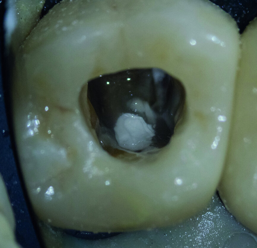Fig. 8 : Dentine et ciment obturés avec G Premio BOND. 