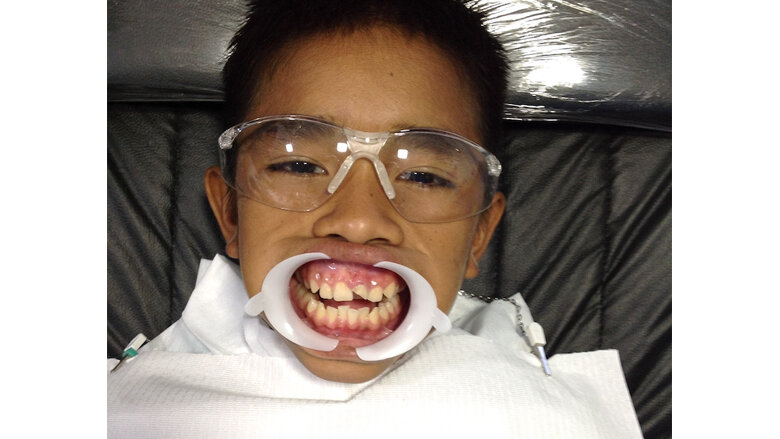 Caso clínico. Figura A. Jorge, de 11 años, solicitó el tratamiento de una fractura en la corona del diente 21.
