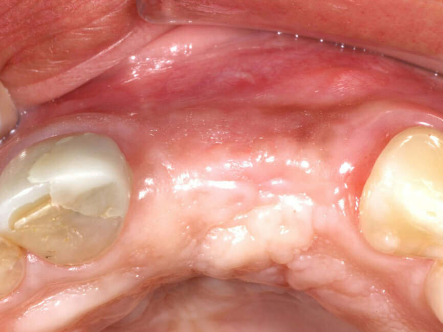 Fig. 15b: The previously deficient ridge at the left central and lateral incisors resulting from resorption following the previously extracted teeth had been augmented and is ready for implant placement following 4.5 months of graft healing.