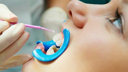 Relatório confirma eficácia dos selantes dentários contra cárie na infância