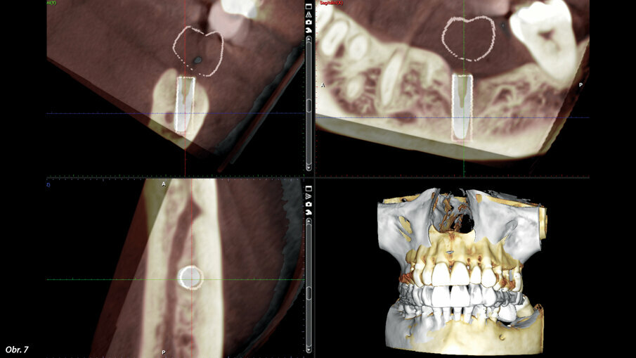 Přesnost navigované implantace – plánovaná pozice je znázorněna bílým válcem. Implantát byl zaveden dle plánu s klinicky nevýznamnou odchylkou.