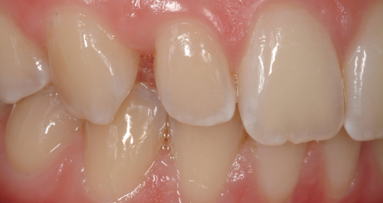 ‘No-Prep’ adhesive restorations: another way to deal with aesthetic deficiencies