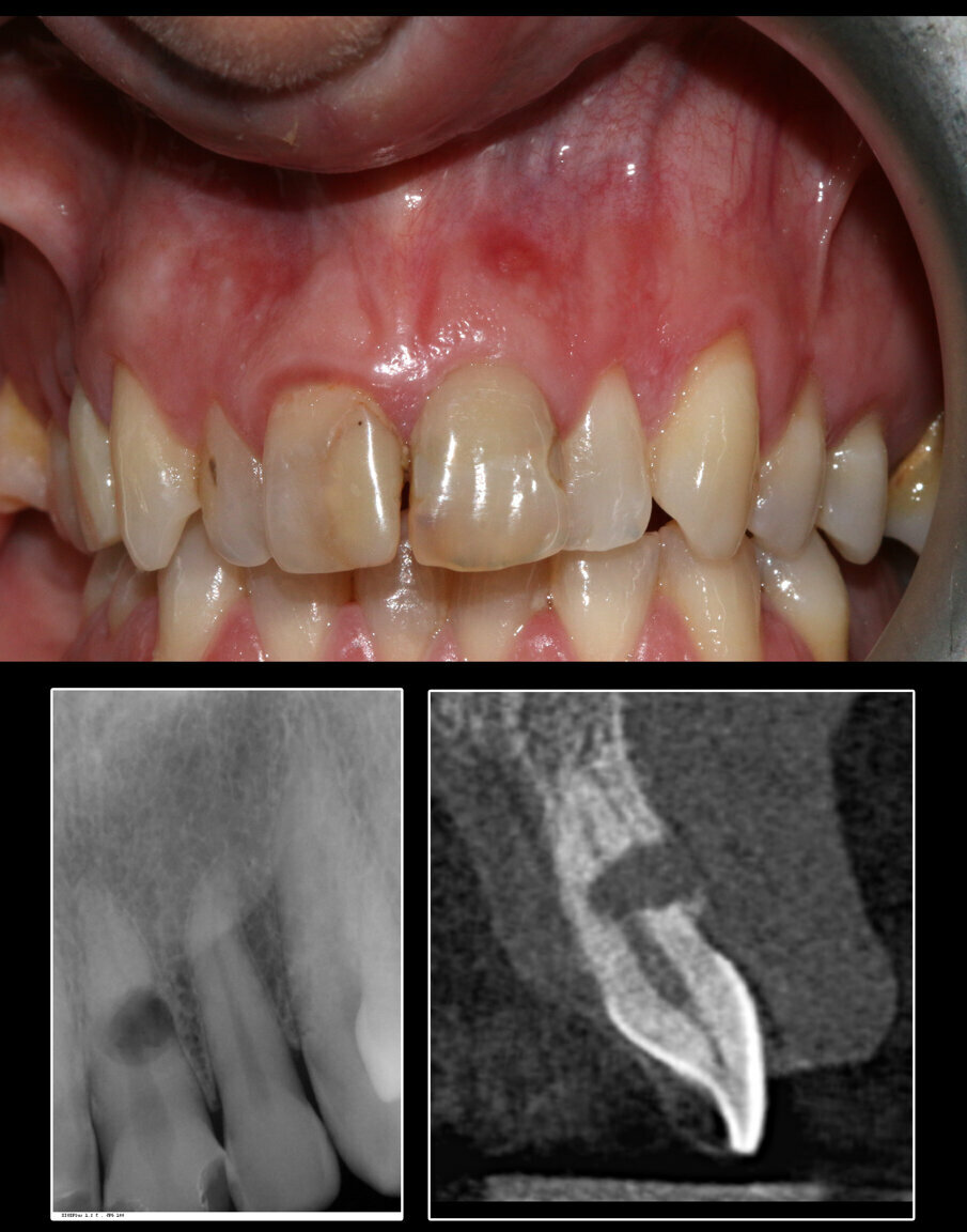 Fig. 1_Esempio di elemento dentario affetto da riassorbimento radicolare esterno non candidabile a SST: la lesione riguarda esattamente l’aspetto vestibolare, tanto da compromettere anche l’integrità del piatto osseo buccale.
