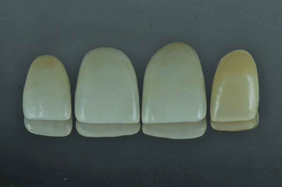 Fig. 8: Fabrication of the final restorations in the laboratory: three Lithium disilicate veneers and a zirconia crown.