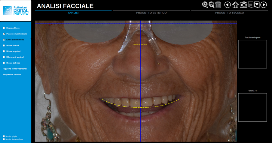 Fig. 3 - L’analisi facciale in fotografia è un passaggio importante del progetto in cui è possibile scoprire quegli aspetti di disarmonia che possono facilmente sfuggire in una osservazione meno attenta dal vivo.