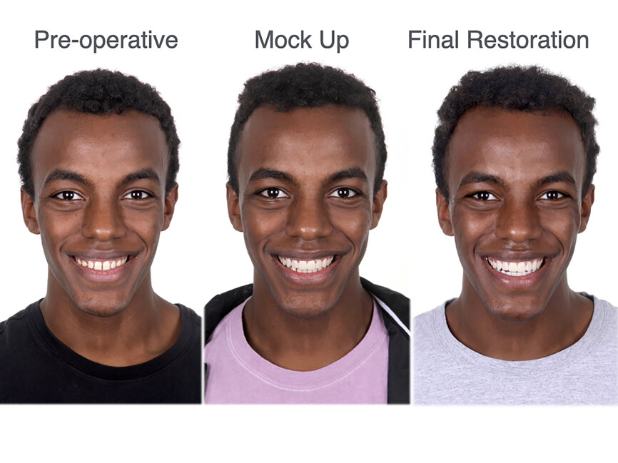 Figs. 86a–c: Pre-op smile and customised smile in facial harmony (a) wearing the mock-up (b) and after definitive restoration (c).