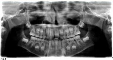 Le futur de l'endodontie : la revascularisation pulpaire
