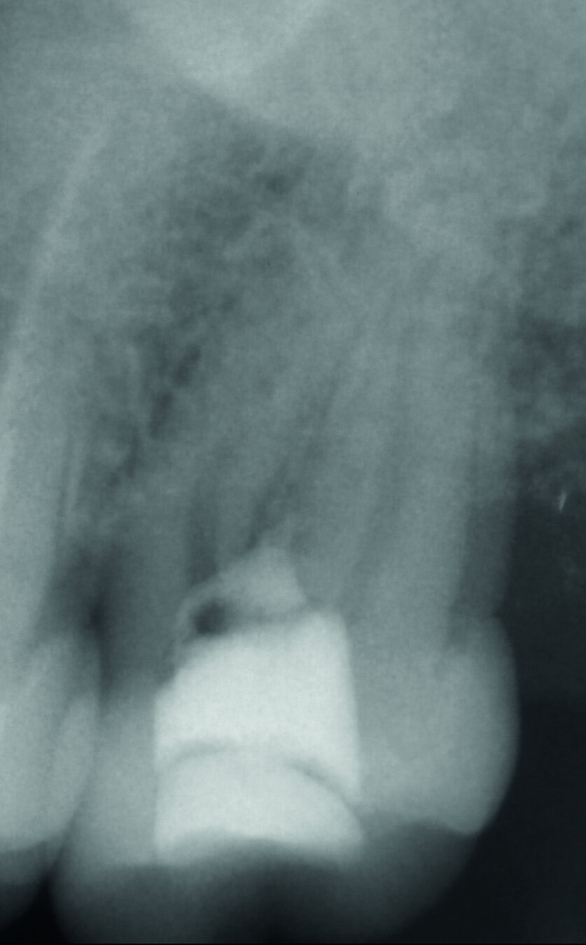 Fig. 5 : Radiographie de la fermeture de la perforation après la première visite. 