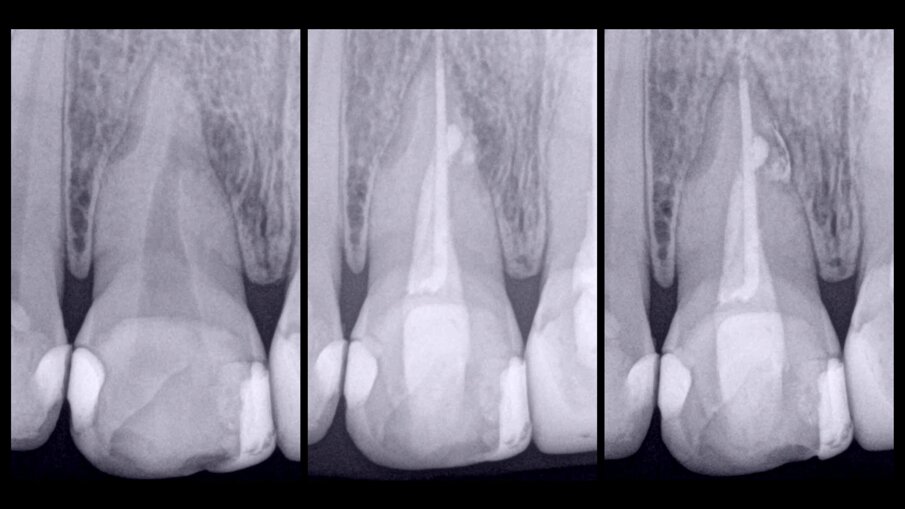 Fig. 8: Radiographic sequence of the treatment performed in tooth #11. Initial radiograph. The root resorption and lateral radiolucent area were evident (a). Completed root canal therapy (b). Three-year follow-up radiograph showing complete healing of the lateral radicular radiolucent area and the correct sealing of the resorption (c).