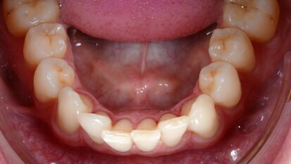 Accelerated aligners with photobiomodulation