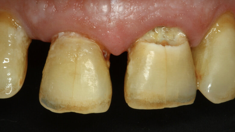 Figura 1. Lesiones de caries cavitadas en dentina activa (ICDAS 5) en dientes 11 y 21 en paciente másculino (Caso 1).