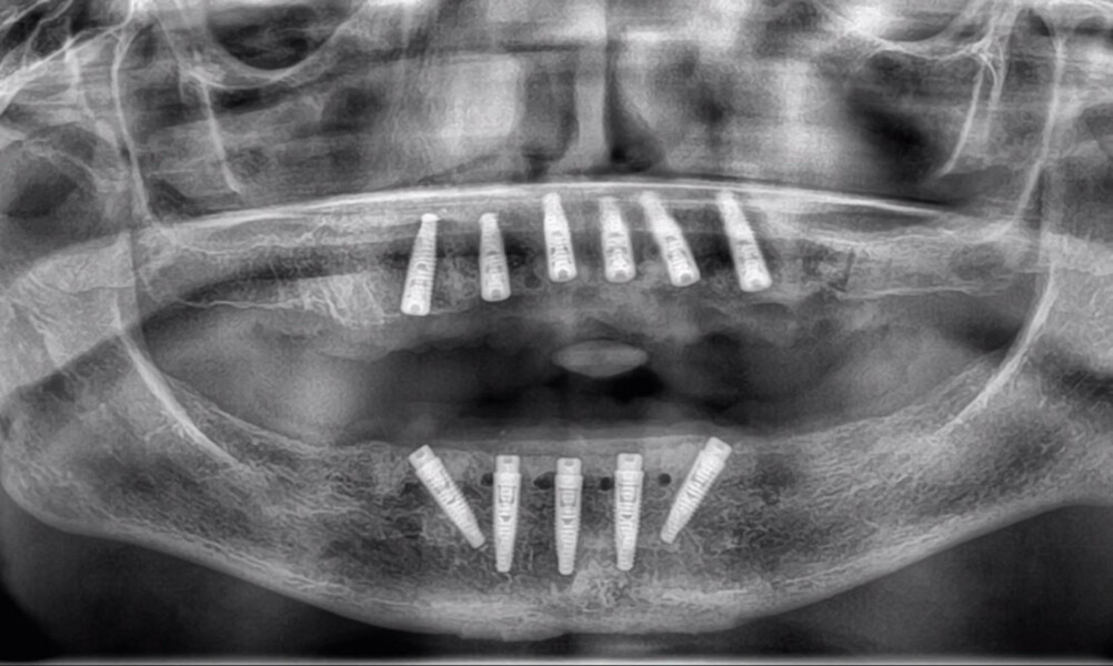 Fig. 20: Post-op panoramic radiograph showing the implants and grafted sites.