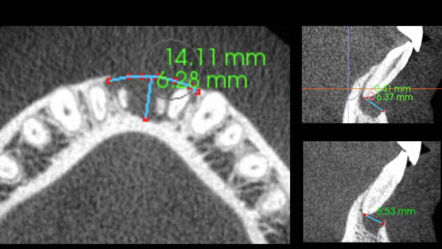 Slike 2a–c: Horizontalni prikaz i-CAT skeniranja koji pokazuje veliki defekt kosti (a). Vertikalni pogledi na oba centralna sekutića koji pokazuju gubitak kosti (b i c)