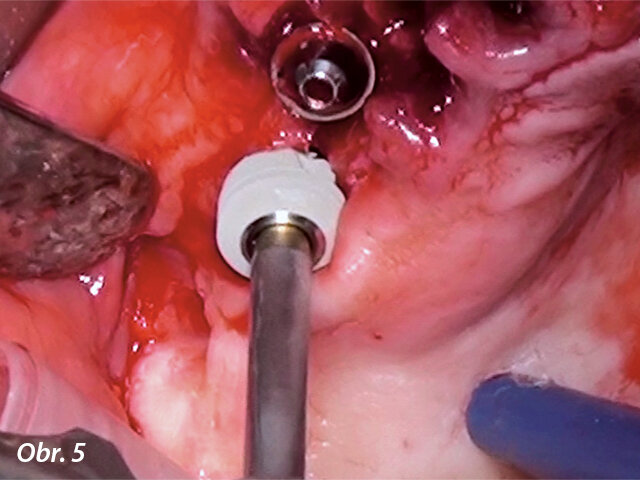 Zavádění ultrakrátkého implantátu do distálního úseku horní čelisti.
