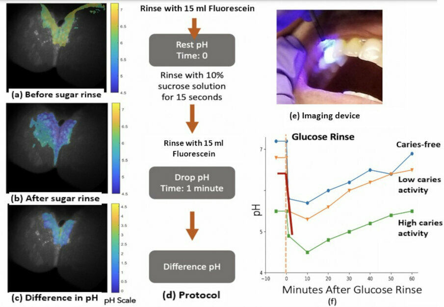 Case study using a multi-mode scanning fiber endoscope (mm-SFE) for pH detection.  Subject had not received professional cleaning in over seven months and had skipped brushing for five days prior to the exam.  (a) Image of interproximal dental biofilm with pH heat map.  (b) The pH heat map after the sugar rinse.  (c) The difference between resting pH and falling pH.  (d) The protocol used for testing with mm-SFE.  The fluorescein is rinsed out instead of being applied to each tooth surface using a blunt hypodermic needle.  (e) The mm-SFE pH probe.  (f) Stephan's curve, red line indicating average pH obtained using images at each stage of resting pH and falling pH.  (Image: University of Washington)